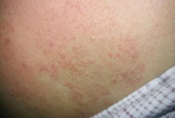 怀孕期间下面痒怎么回事（孕妇到35周的时候下面很痒怎么办）