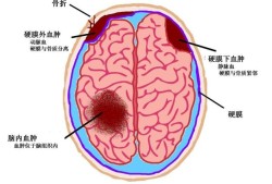 胎儿颅内出血（胎儿颅内出血原因）