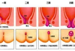孕期肛门出血怎么办（孕期肛门出血怎么办?）
