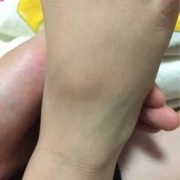 婴儿脚背骨头凸起是怎么了,胎儿骨骼发育不良原因有哪些