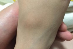 婴儿脚背骨头凸起是怎么了,胎儿骨骼发育不良原因有哪些