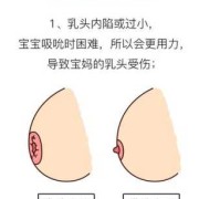 哺乳期乳头皲裂怎么快速治愈,孕期乳头皲裂怎么办才