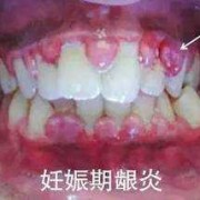 孕期牙龈出血是怎么回事（孕期牙龈出血是怎么回事儿）