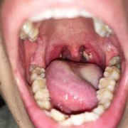 孕妇扁桃体化脓了怎么办,孕妇牙齿流脓会影响胎儿吗
