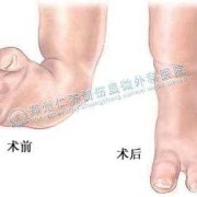 胎儿足内翻（胎儿足内翻是什么原因导致的）