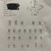 胎儿染色体异常（染色体异常的胎儿能要吗）