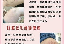 孕期肥胖纹（孕期肥胖纹会自己消吗）