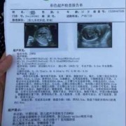 地贫胎儿（地贫胎儿超声表现）
