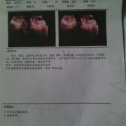 胎儿b超（孕14周b超准确率多高）