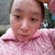 孕期痤疮怎么办（孕妇脸上长痘痘怎么调理？快四个月了，需要使用药物的吗）