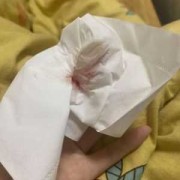孕期鼻子出血正常吗（为什么孕晚期鼻子容易出血）