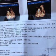 胎儿胆囊大（32周胎儿胆囊偏大38乘以11mm严重吗）