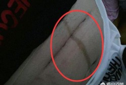 孕期妊娠线（为什么怀孕没有妊娠线啊）