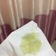 孕期白带脓性（孕妇白带发绿怎么办）