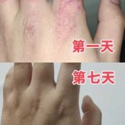 备孕期间湿疹怎么办（备孕期间湿疹怎么办啊）