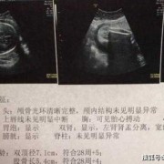 b超mi是什么意思,胎儿b超指数参考