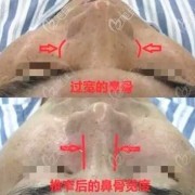 鼻梁骨短怎么办,胎儿鼻骨偏短会导致什么