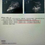侧胎儿体重（b超体重跟胎儿实际体重相差多少）