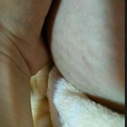 孕期胸部长妊娠纹（怀孕之后为什么会长妊娠纹）