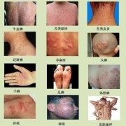 孕期起湿疹怎么办（孕妇阴部得了湿疹怎么办）