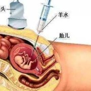 羊水穿刺后胎儿死了（孕妇做羊水穿刺有多大风险）