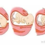 孕期漏胎（浮胎是什么意思）