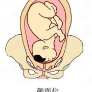 胎儿仰后位（胎儿仰后位）