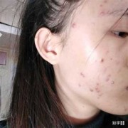 孕期下巴长痘（孕期下巴长痘痘是什么原因造成的）