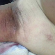 孕期腋下湿疹怎么办（孕期腋下湿疹怎么办）