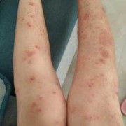 怀孕了得荨麻疹怎么办,孕妇有荨麻疹会不会影响胎儿