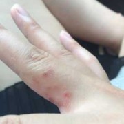 手指痒怎么办,孕期手指痒挠后有小水泡怎么回事