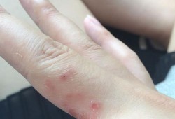 手指痒怎么办,孕期手指痒挠后有小水泡怎么回事