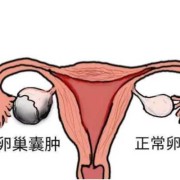 孕期卵巢囊肿（孕期卵巢囊肿影响胎儿吗）