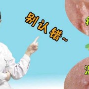 孕期疱疹复发怎么处理（复发性疱疹怎么办）