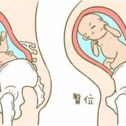 胎儿偏向肚子左边（胎儿往左边肚子歪怎么办）