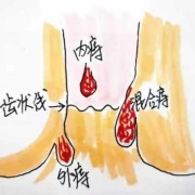 孕妇痔疮出来了要怎么办好,孕期内痔疮大便出血怎么办