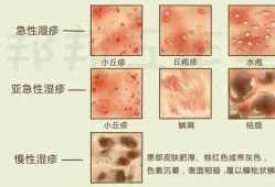 孕期外阴湿疹擦什么好（下身外阴有湿疹怎么办）