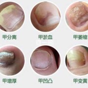 孕期灰指甲怎么办（孕妇有灰指甲怎么办?）
