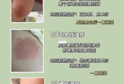 孕期怎么预防婴儿湿疹（怀孕期间一直长湿疹，对宝宝有没有影响）