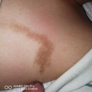 孕妇怎样避免胎儿胎记（孕妇撞到肚子会有胎记吗）