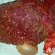 胎儿肝畸形（肝血管瘤会癌变吗）