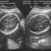 胎儿心脏异常孕期表现（怀孕七个月胎儿心脏室间隔穿隔血流怎么回事）