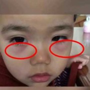 胎儿变黑吗（医生我家宝宝快八个月了眼下面发黑是什么原因）