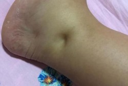 孕期水肿生女儿吗（孕期为什么会水肿）