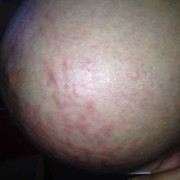 孕期肚皮红点（孕妇肚子上起红点还痒怎么办最好）