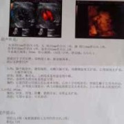 单肾胎儿（四维彩超双肾分离怎么回事）