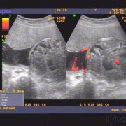 医生请问怀孕做彩超说孩子腹部肠胃管略扩张怎么回事,胎儿结肠扩张是什么原因导致的