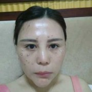 孕期色素沉着多久恢复（孕期色素沉着多久恢复正常）