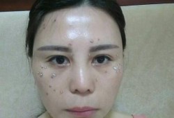 孕期色素沉着多久恢复（孕期色素沉着多久恢复正常）