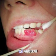 孕期牙龈出血严重怎么办（孕妇牙龈出血会影响胎儿吗）
